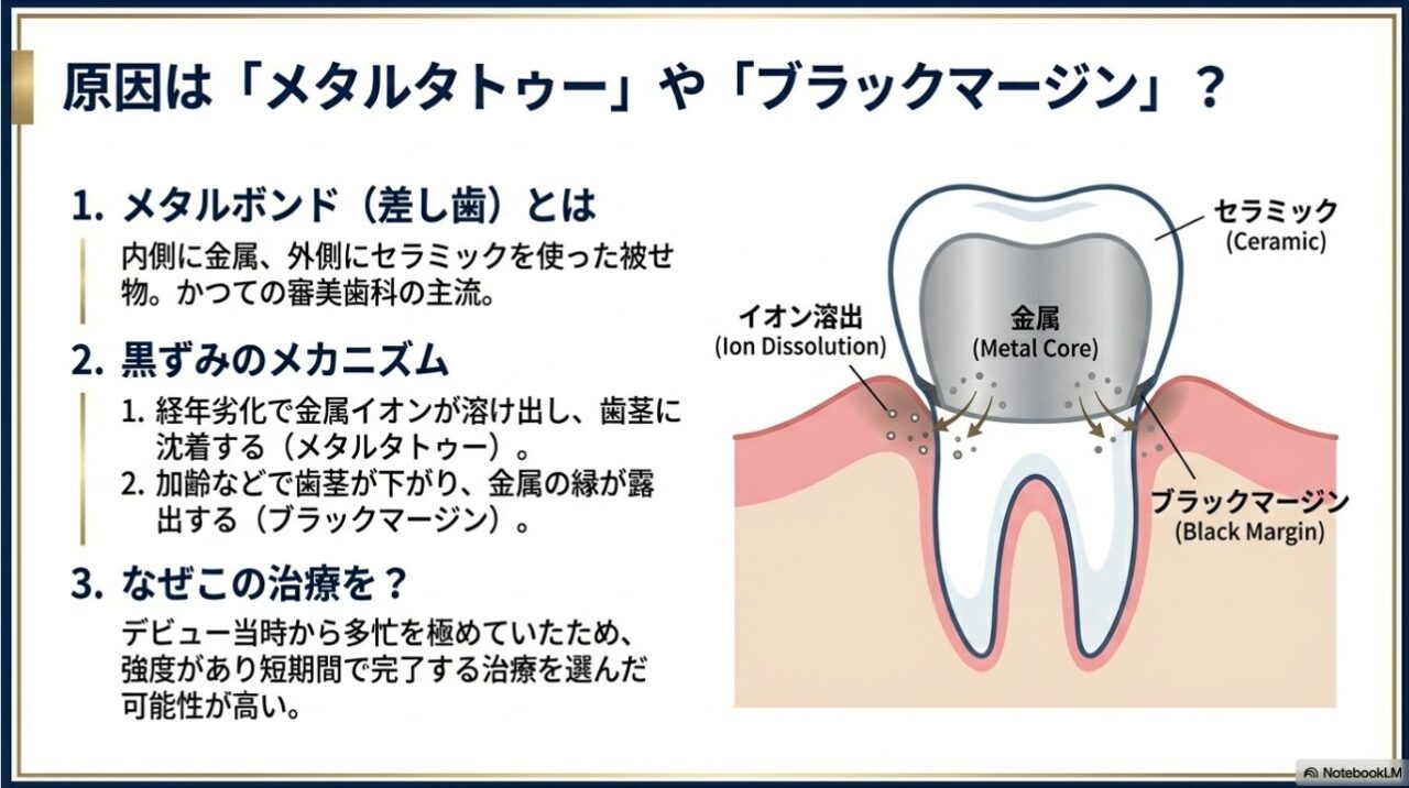 差し歯の金属イオンが溶け出し歯茎が黒くなるメタルタトゥーとブラックマージンの解説図